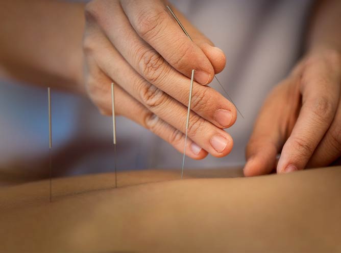 Thumbnail Acupuncture